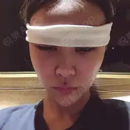 今天是手术的第五天了啊,一大早起床就过来码字,希望...眼综合整形悦美整形
