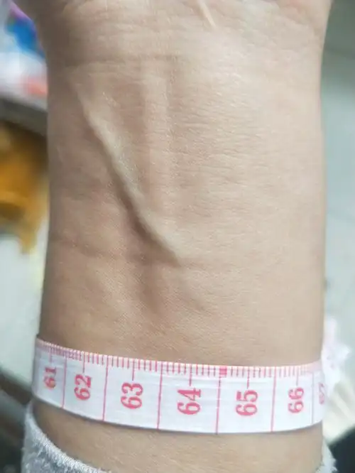 两手腕血管不一样粗细是怎么回事