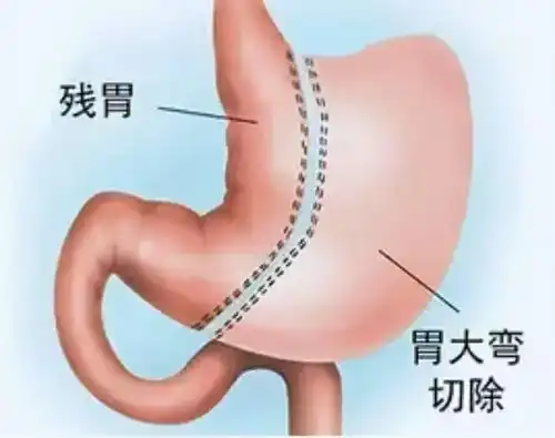 缩胃手术减肥手术医疗险被拒赔怎么破