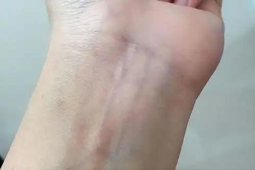 手腕血管是显微镜若发现已有这几个表现,或是动脉瘤找上门