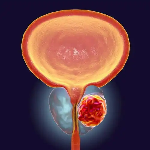 nejm激素敏感性前列腺癌的治疗