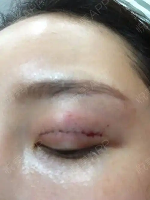 眼睛已经做好了还看得见伤...眼综合整形悦美整形