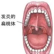 2岁左右的小孩得了扁桃体化脓该怎么办