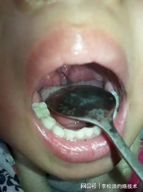 三岁的孩子扁桃体腺体肥大还有鼻窦炎,请问可以灼烙治疗吗