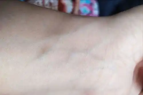手腕血管是显微镜若发现已有这几个表现,或是动脉瘤找上门