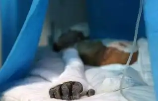 13岁少年火烧女教师被免刑少年泼汽油烧伤女教师