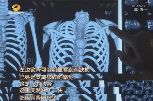12岁男孩肺癌晚期医生肺癌低龄化可能和这几个因素有关
