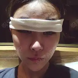 今天是手术的第五天了啊,一大早起床就过来码字,希望...眼综合整形悦美整形