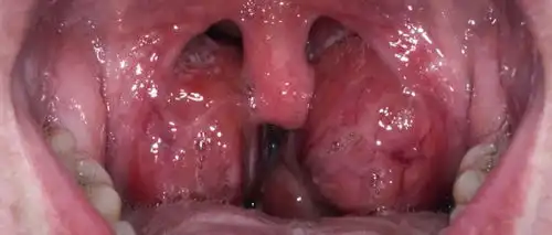 竟然34的孩子有腺样体肥大,保守还是手术