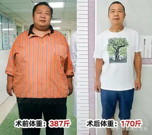 选择缩胃手术减肥这种减肥方法到底哪里好
