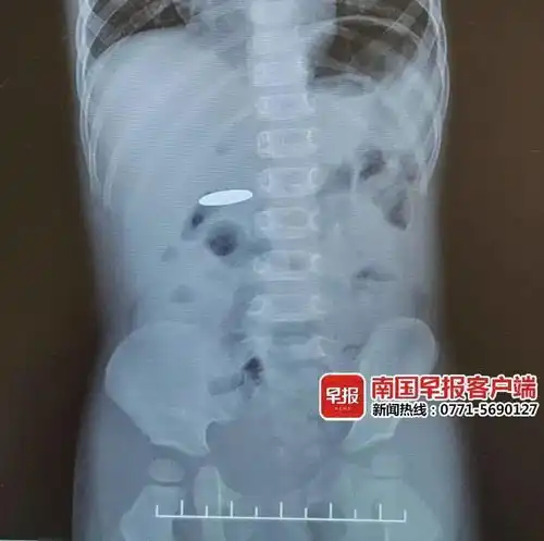 1岁男童误吞电池求医,手术前吃了一碗粉,差点出大事