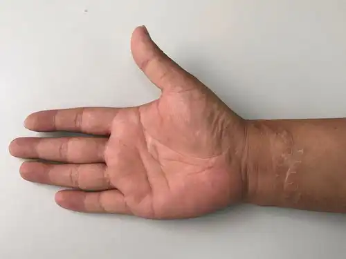 手腕部肌腱神经血管断裂