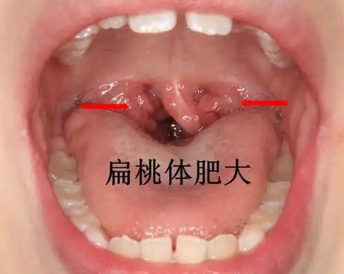 中医如何治疗儿童扁桃体肥大扁桃体肥大的中医治疗方法