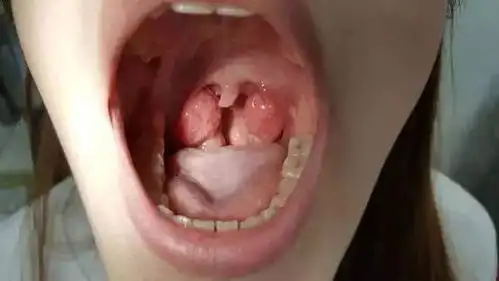 你的扁桃体切错了吗