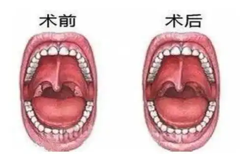10岁女孩扁桃体微创手术身亡,小手术为什么能送命怎么会导致肺部出血