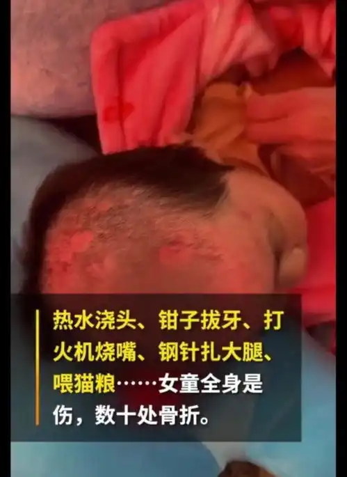 触目惊心热水浇头钳子拔牙,6岁女童遭亲妈及其男友虐待