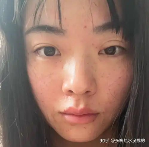 听皮肤科医生一句劝,脸上长斑真不用来看