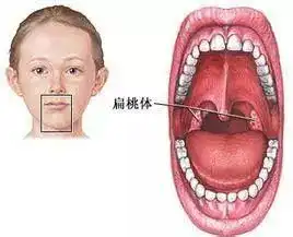 宝宝扁桃体反复发炎,如何预防