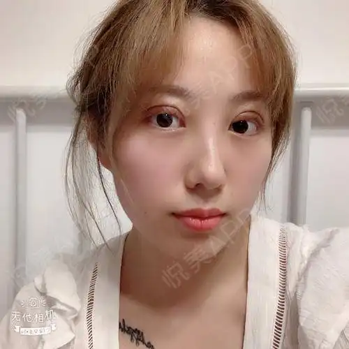 这两天眼睛恢复的还挺好的,就是还比较肿,希望能恢复...眼综合整形悦美整形